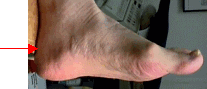 retrocalcanealbursitis.gif (12250 bytes)